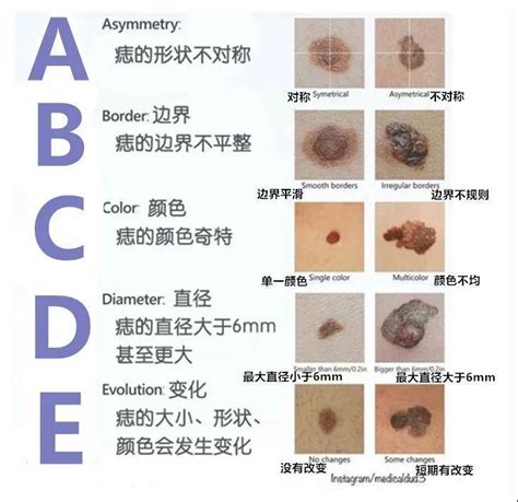 長痣的位置|“ABCDE法”——自我识别痣的良性与恶性